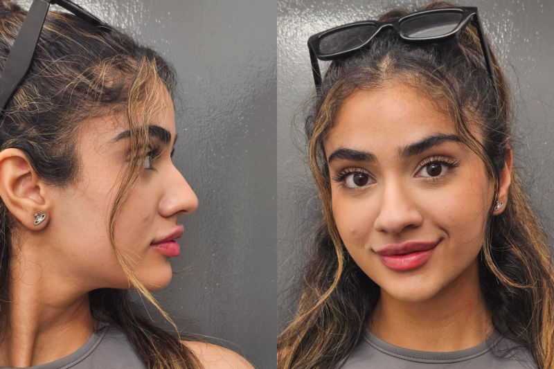 Natural Result Lip Fillers with Dr Matla  in Newcastle